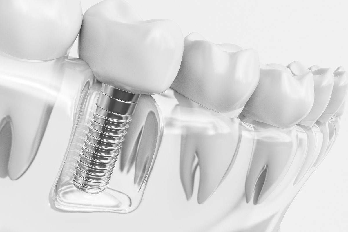 Single Dental Implant